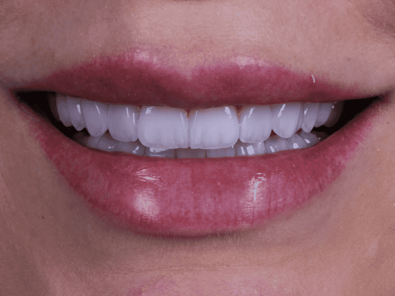 Mitos e Verdades sobre Lentes de Contato Dental: Tudo o que Você Precisa Saber Antes de Transformar seu Sorriso