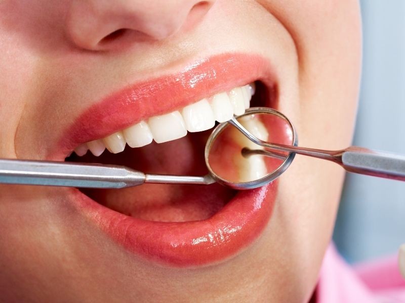 Lente de Contato Dental: Tudo o que você precisa saber para transformar o seu sorriso