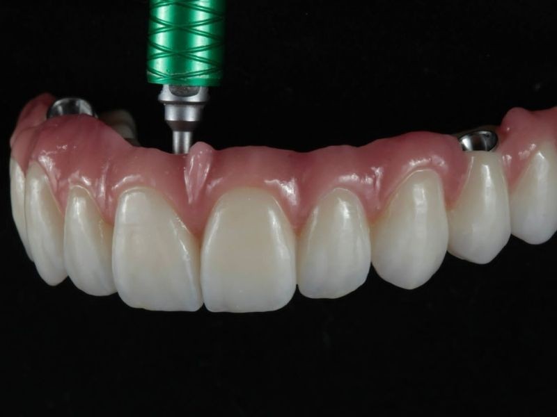 Tipos de Prótese Dentária: O Guia Completo Para o Sorriso Perfeito