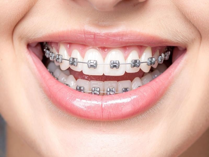 Aparelho Fixo em Porto Alegre