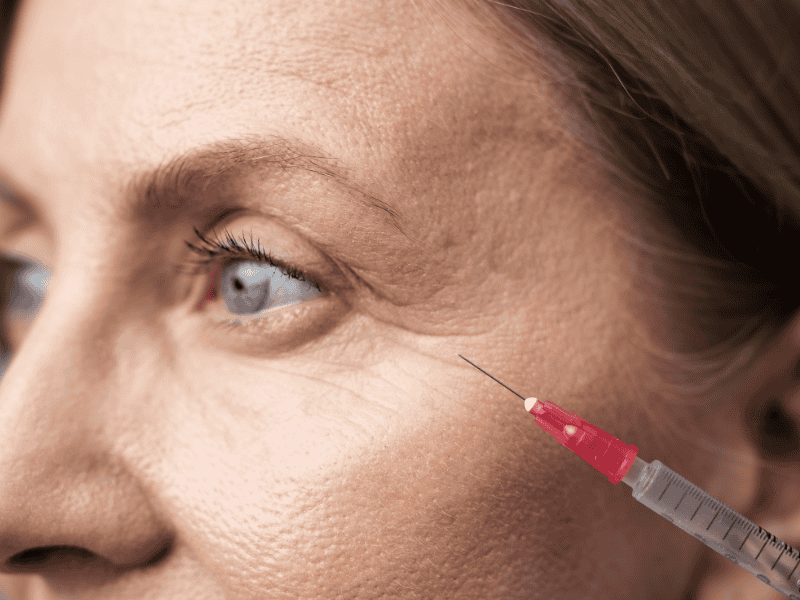 Preenchimento de Olheiras em Porto Alegre