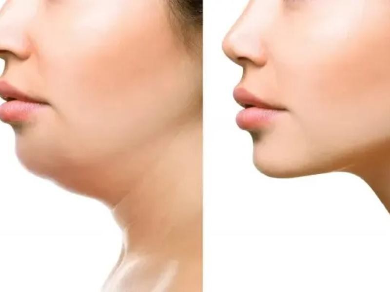 Preenchimento de Mento em Porto Alegre